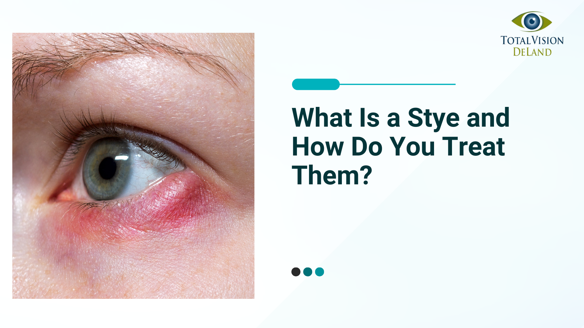 What Is a Stye and How Do You Treat Them? - Total Vision of Deland